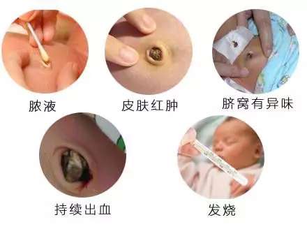 臍帶怎么樣消 毒？應(yīng)該注意什么事項？