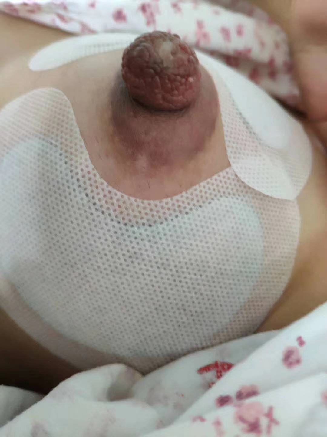 我乳頭上有白點(diǎn)，月嫂說是乳頭水泡，哺乳時(shí)間乳頭疼，怎么辦？